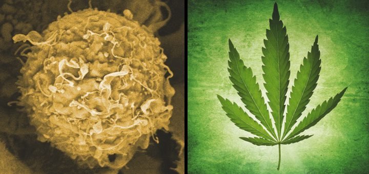מחקר מראה: CBD מונע התפתחות גרורות סרטן השד